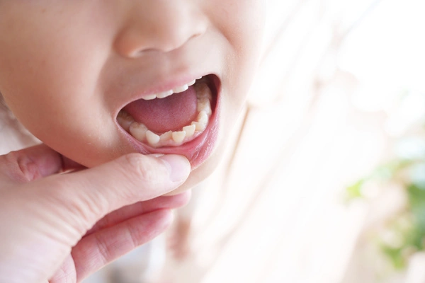 子どものうちに矯正が必要な理由