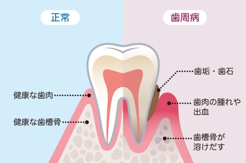 半が歯周病が原因