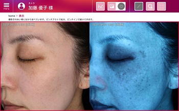 re-Beauによる肌撮影